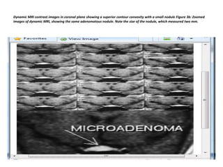 Dynamic MRI contrast images in coronal plane showing a superior contour convexity with a small nodule Figure 3b: Zoomed
images of dynamic MRI, showing the same adenomatous nodule. Note the size of the nodule, which measured two mm.

 