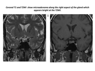 Coronal T1 and T2WI show microadenoma along the right aspect of the gland which
appears bright at the T2WI.

 