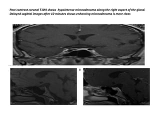 Post-contrast coronal T1WI shows hypointense microadenoma along the right aspect of the gland.
Delayed sagittal images after 10 minutes shows enhancing microadenoma is more clear.

 