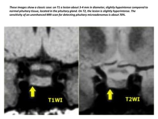 These images show a classic case: on T1 a lesion about 3-4 mm in diameter, slightly hypointense compared to
normal pituitary tissue, located in the pituitary gland. On T2, the lesion is slightly hyperintense. The
sensitivity of an unenhanced MRI scan for detecting pituitary microadenomas is about 70%.

 