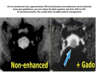 On an unenhanced scan, approximately 70% of all pituitary macroadenoma can be detected.
If you give gadolinium, you can reduce the false-negative rate from 30% to 15%.
As mentioned earlier, this usually does not affect patient management.

 