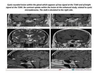 Cystic rounded lesion within the gland which appears of low signal at the T1WI and of bright
signal at the T2WI. No contrast uptake within the lesion at the enhanced study, related to cystic
microadenoma. The stalk is deviated to the right side.

 