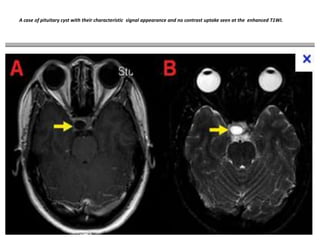 A case of pituitary cyst with their characteristic signal appearance and no contrast uptake seen at the enhanced T1WI.

 
