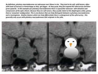 By definition, pituitary macroadenoma are adenomas over 10mm in size. They tend to be soft, solid lesions, often
with areas of necrosis or hemorrhage as they get bigger. As they grow, they first expand the sella turcica and then
grow upwards. In this example of a pituitary macroadenoma there is suprasellar extension with elevation and
compression of the optic chiasm. Because they are soft tumors, they usually indent at the diaphragma sellae, giving
them a 'snowman' configuration. This is one feature that can help distinguish between a pituitary macroadenoma
and a meningioma. Another feature which can help differentiate them is enlargement of the sella turcica - this
generally only occurs with pituitary macroadenoma that originate in the sella.

 