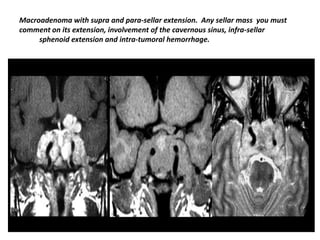 Macroadenoma with supra and para-sellar extension. Any sellar mass you must
comment on its extension, involvement of the cavernous sinus, infra-sellar
sphenoid extension and intra-tumoral hemorrhage.

 