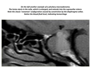 On the left another example of a pituitary macroadenoma.
The lesion starts in the sella, which is enlarged, and extends into the suprasellar cistern.
Note the classic 'snowman' configuration caused by constriction by the diaphragma sellae.
Notice the blood-fluid level, indicating hemorrhage

 