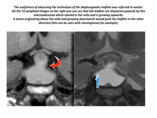 The usefulness of observing the inclination of the diaphragmatic leaflets was referred to earlier.
On the T2-weighted images on the right you can see that the leaflets are displaced upwards by this
macroadenoma which started in the sella and is growing upwards.
A lesion originating above the sella and growing downwards would push the leaflets in the other
direction (this can be seen with meningiomas for example).

 