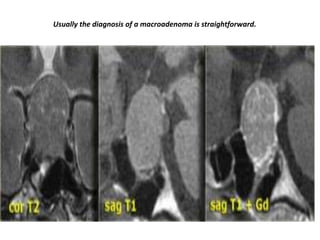 Usually the diagnosis of a macroadenoma is straightforward.

 