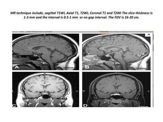MR technique include, sagittal T1WI, Axial T1, T2WI, Coronal T1 and T2WI The slice thickness is
1-3 mm and the interval is 0.5-1 mm or no gap interval. The FOV is 16-20 cm.

 