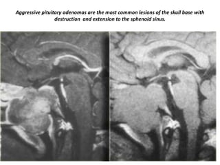 Aggressive pituitary adenomas are the most common lesions of the skull base with
destruction and extension to the sphenoid sinus.

 