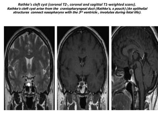 Rathke's cleft cyst (coronal T2-, coronal and sagittal T1-weighted scans).

Rathke's cleft cyst arise from the craniopharyngeal duct (Rathke's, s pouch) (An epithelial
structures connect nasopharynx with the 3rd ventricle , involutes during fetal life).

 