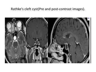Rathke's cleft cyst(Pre and post-contrast images).

 