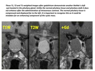These T1, T2 and T1-weighted images after gadolinium demonstrate another Rathke's cleft
cyst located in the pituitary gland. Unlike the normal pituitary tissue and pituitary stalk it does
not enhance after the administration of intravenous contrast. The normal pituitary tissue is
compressed and displaced far to the left. It is important to recognize this as it could be
mistaken for an enhancing component of the cystic mass.

 