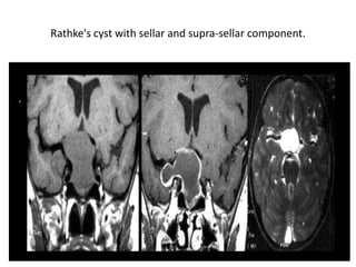 Rathke's cyst with sellar and supra-sellar component.

 