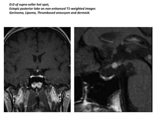D.D of supra-sellar hot spot,
Ectopic posterior lobe on non-enhanced T1-weighted images
Gerinoma, Lipoma, Thrombosed aneurysm and dermoid.

 
