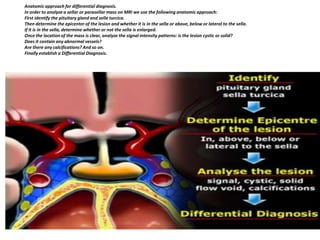 Anatomic approach for differential diagnosis.
In order to analyze a sellar or parasellar mass on MRI we use the following anatomic approach:
First identify the pituitary gland and sella turcica.
Then determine the epicenter of the lesion and whether it is in the sella or above, below or lateral to the sella.
If it is in the sella, determine whether or not the sella is enlarged.
Once the location of the mass is clear, analyze the signal intensity patterns: is the lesion cystic or solid?
Does it contain any abnormal vessels?
Are there any calcifications? And so on.
Finally establish a Differential Diagnosis.

 