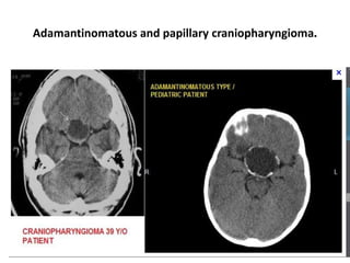 Adamantinomatous and papillary craniopharyngioma.

 