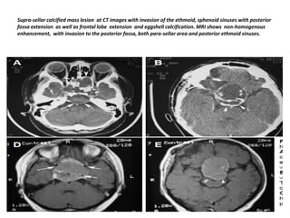 Supra-sellar calcified mass lesion at CT images with invasion of the ethmoid, sphenoid sinuses with posterior
fossa extension as well as frontal lobe extension and eggshell calcification. MRI shows non-homogenous
enhancement, with invasion to the posterior fossa, both para-sellar area and posterior ethmoid sinuses.

 