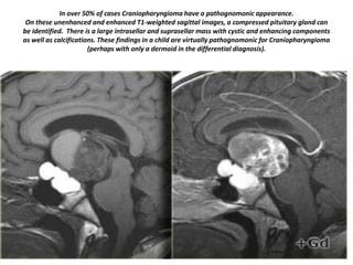 In over 50% of cases Craniopharyngioma have a pathognomonic appearance.
On these unenhanced and enhanced T1-weighted sagittal images, a compressed pituitary gland can
be identified. There is a large intrasellar and suprasellar mass with cystic and enhancing components
as well as calcifications. These findings in a child are virtually pathognomonic for Craniopharyngioma
(perhaps with only a dermoid in the differential diagnosis).

 