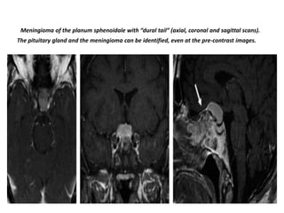 Meningioma of the planum sphenoidale with “dural tail” (axial, coronal and sagittal scans).
The pituitary gland and the meningioma can be identified, even at the pre-contrast images.

 