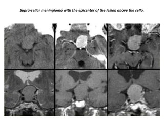 Supra-sellar meningioma with the epicenter of the lesion above the sella.

 