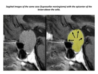 Sagittal images of the same case (Suprasellar meningioma) with the epicenter of the
lesion above the sella.

 