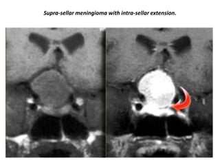 Supra-sellar meningioma with intra-sellar extension.

 