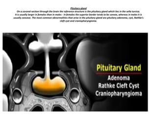 Pituitary gland
On a coronal section through the brain the reference structure is the pituitary gland which lies in the sella turcica.
It is usually larger in females than in males - in females the superior border tends to be convex, whereas in males it is
usually concave. The most common abnormalities that arise in the pituitary gland are pituitary adenoma, cyst, Rathke's
cleft cyst and craniopharyngioma.

 