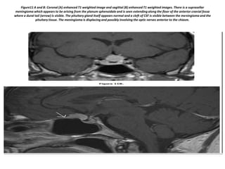 Figure11 A and B: Coronal (A) enhanced T1 weighted image and sagittal (B) enhanced T1 weighted images. There is a suprasellar
meningioma which appears to be arising from the planum sphenoidale and is seen extending along the floor of the anterior cranial fossa
where a dural tail (arrow) is visible. The pituitary gland itself appears normal and a cleft of CSF is visible between the meningioma and the
pituitary tissue. The meningioma is displacing and possibly involving the optic nerves anterior to the chiasm.

 