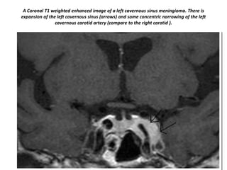 A Coronal T1 weighted enhanced image of a left cavernous sinus meningioma. There is
expansion of the left cavernous sinus (arrows) and some concentric narrowing of the left
cavernous carotid artery (compare to the right carotid ).

 