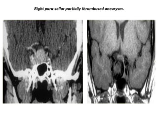 Right para-sellar partially thrombosed aneurysm.

 