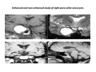 Enhanced and non-enhanced study of right para-sellar aneurysm.

 