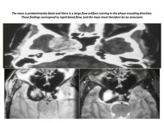 The mass is predominantly black and there is a large flow artifact running in the phase-encoding direction.
These findings correspond to rapid blood flow, and the mass must therefore be an aneurysm

 