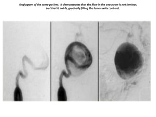 Angiogram of the same patient. It demonstrates that the flow in the aneurysm is not laminar,
but that it swirls, gradually filling the lumen with contrast.

 
