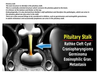 Pituitary stalk

The next structure to identify is the pituitary stalk.
This is a vertically oriented structure which connects the pituitary gland to the brain.
It is thinner at the bottom and thicker at the top.
Embryologically, it is also derived from Rathke's cleft epithelium and therefore the pathologies, which can arise in
the pituitary gland can also arise in the stalk.
There are a few unusual things to be considered in children, such as germinomas and eosinophilic granulomas.
In adults metastases and occasionally lymphoma can arise in the pituitary stalk.

 
