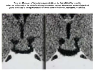These are CT images of hamartoma suspended from the floor of the third ventricle.
It does not enhance after the administration of intravenous contrast. Hamartoma masses of dysplastic
found exclusively in young children and the most common location is floor of the 3rd ventricle.

 