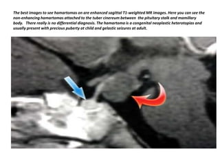 The best images to see hamartomas on are enhanced sagittal T1-weighted MR images. Here you can see the
non-enhancing hamartomas attached to the tuber cinereum between the pituitary stalk and mamillary
body. There really is no differential diagnosis. The hamartoma is a congenital neoplastic heterotopias and
usually present with precious puberty at child and gelastic seizures at adult.

 