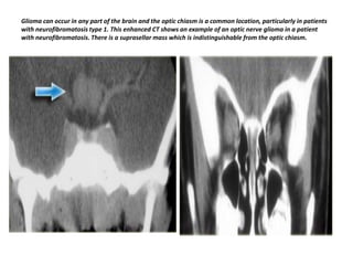 Glioma can occur in any part of the brain and the optic chiasm is a common location, particularly in patients
with neurofibromatosis type 1. This enhanced CT shows an example of an optic nerve glioma in a patient
with neurofibromatosis. There is a suprasellar mass which is indistinguishable from the optic chiasm.

 