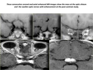 These consecutive coronal and axial enhanced MR-images show the mass at the optic chiasm
and the swollen optic nerves with enhancement at the post-contrast study.

 