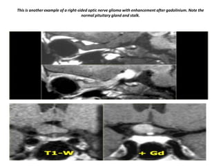This is another example of a right-sided optic nerve glioma with enhancement after gadolinium. Note the
normal pituitary gland and stalk.

 
