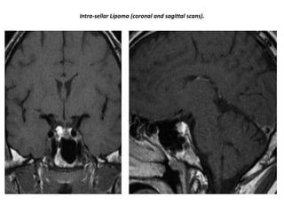 Intra-sellar Lipoma (coronal and sagittal scans).

 