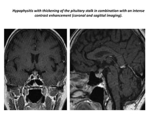 Hypophysitis with thickening of the pituitary stalk in combination with an intense
contrast enhancement (coronal and sagittal imaging).

 