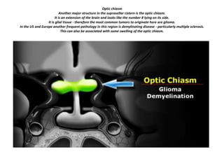 Optic chiasm
Another major structure in the suprasellar cistern is the optic chiasm.
It is an extension of the brain and looks like the number 8 lying on its side.
It is glial tissue - therefore the most common tumors to originate here are glioma.
In the US and Europe another frequent pathology in this region is demylinating disease - particularly multiple sclerosis.
This can also be associated with some swelling of the optic chiasm.

 
