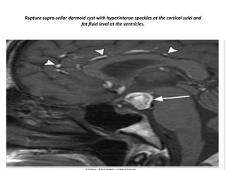 Rupture supra-sellar dermoid cyst with hyperintense speckles at the cortical sulci and
fat fluid level at the ventricles.

 
