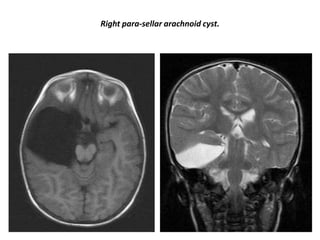 Right para-sellar arachnoid cyst.

 