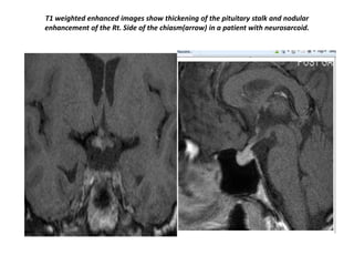 T1 weighted enhanced images show thickening of the pituitary stalk and nodular
enhancement of the Rt. Side of the chiasm(arrow) in a patient with neurosarcoid.

 