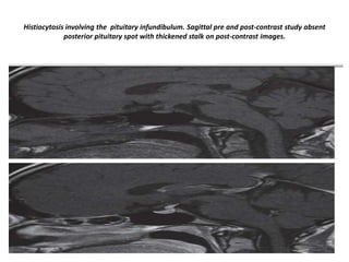 Histiocytosis involving the pituitary infundibulum. Sagittal pre and post-contrast study absent
posterior pituitary spot with thickened stalk on post-contrast images.

 