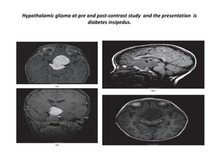 Hypothalamic glioma at pre and post-contrast study and the presentation is
diabetes insipedus.

 