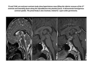 T2 and T1WI, pre and post-contrast study show hyperintense mass filling the inferior recesses of the 3rd
ventricle and extending down along the infundibulum into pituitary fossa. It demonstrate homogenous
contrast uptake. The pineal body is also involved, related to supra-sellar germinoma.

 