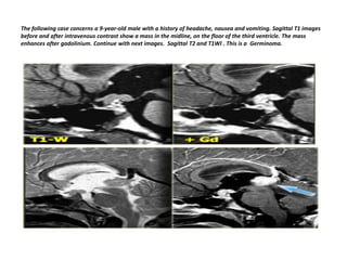 The following case concerns a 9-year-old male with a history of headache, nausea and vomiting. Sagittal T1 images
before and after intravenous contrast show a mass in the midline, on the floor of the third ventricle. The mass
enhances after gadolinium. Continue with next images. Sagittal T2 and T1WI . This is a Germinoma.

 
